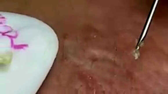 Удаляем прыщи и черные точки: видео для самых смелых зрителей фото 2