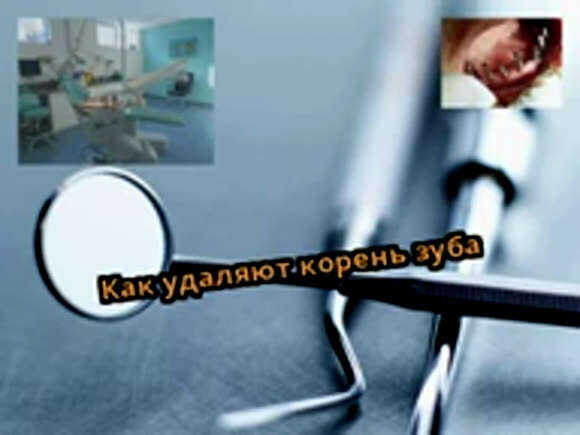 Как удаляют корень зуба: методы, этапы и восстановление фото 4