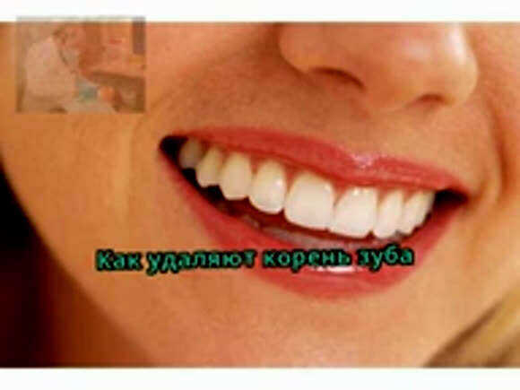 Как удаляют корень зуба: методы, этапы и восстановление фото 6